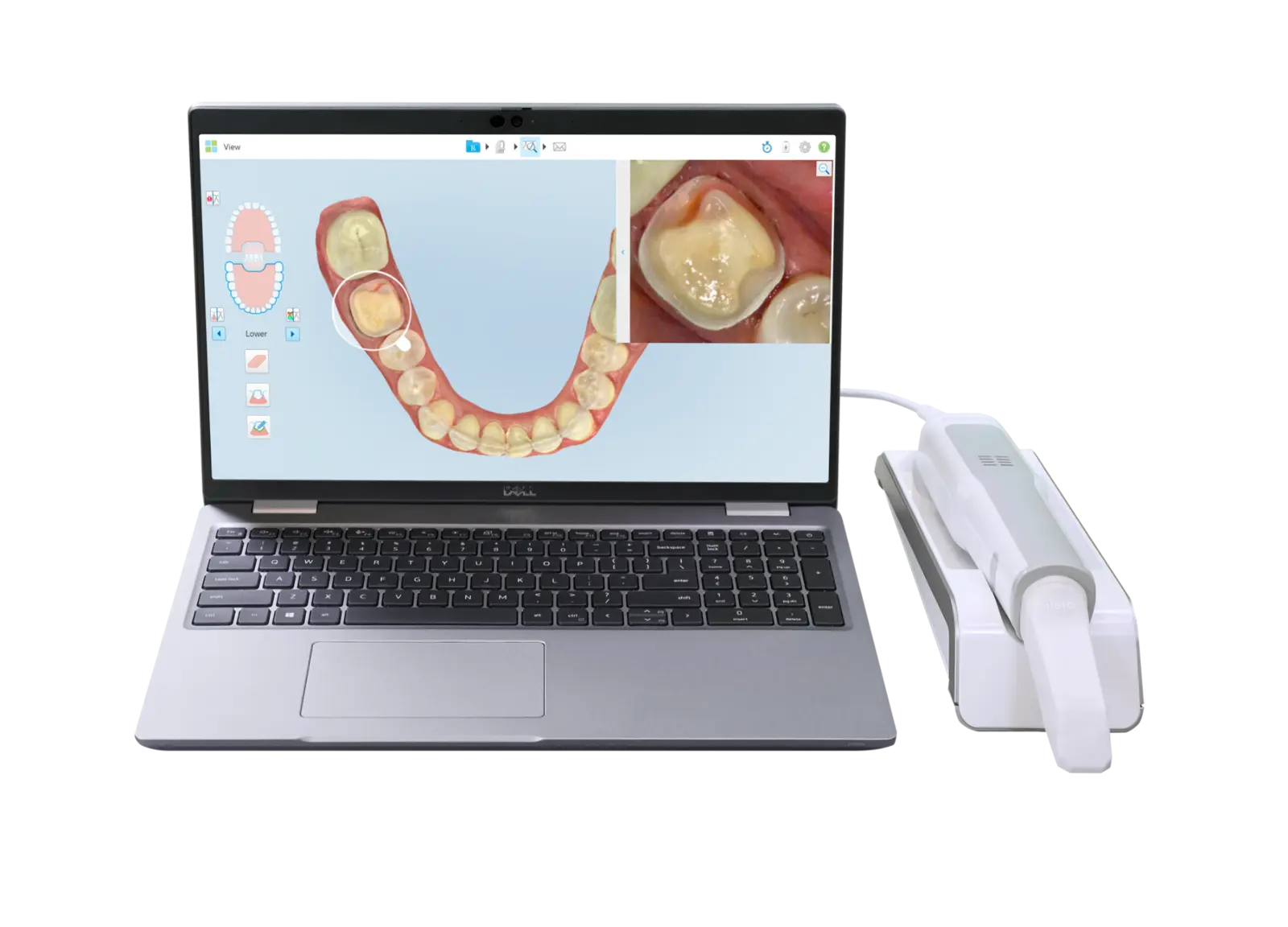 iTero Element 5D digital scanner, laptop and scanning wand used for Invisalign planning