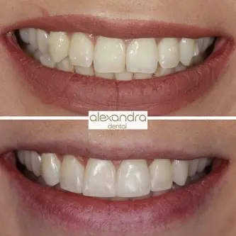 Alexandra Dental treatment result 8: before and after a natural, carefully finished result