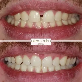 Alexandra Dental treatment result 1: before and after closing a front-tooth gap