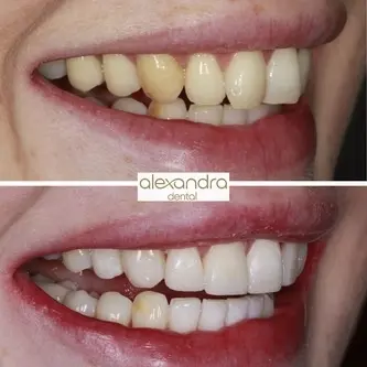 Alexandra Dental treatment result 10: before and after creating space and restoring balance
