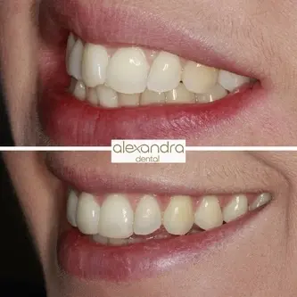 Alexandra Dental treatment result 2: before and after a softer, more balanced smile line