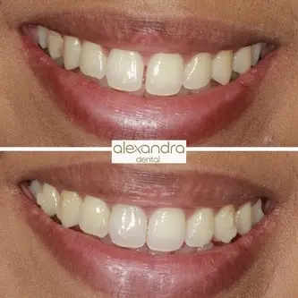 Alexandra Dental treatment result 3: before and after refining spacing and symmetry