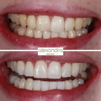 Alexandra Dental treatment result 7: before and after bringing the front teeth into line