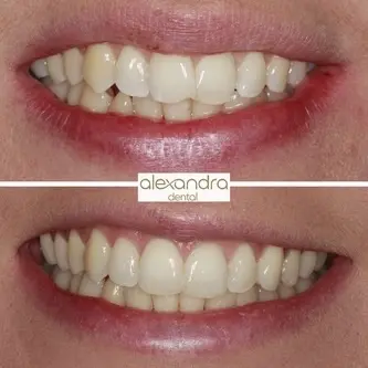 Alexandra Dental treatment result 4: before and after improving alignment and smile balance