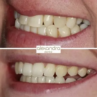 Alexandra Dental treatment result 5: before and after correcting crowding from the side