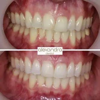 Alexandra Dental treatment result 9: before and after improving alignment across both arches