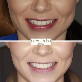 Alexandra Dental treatment result 6: before and after a wider, more confident smile