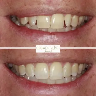 Alexandra Dental treatment result 11: before and after subtle alignment with a natural finish