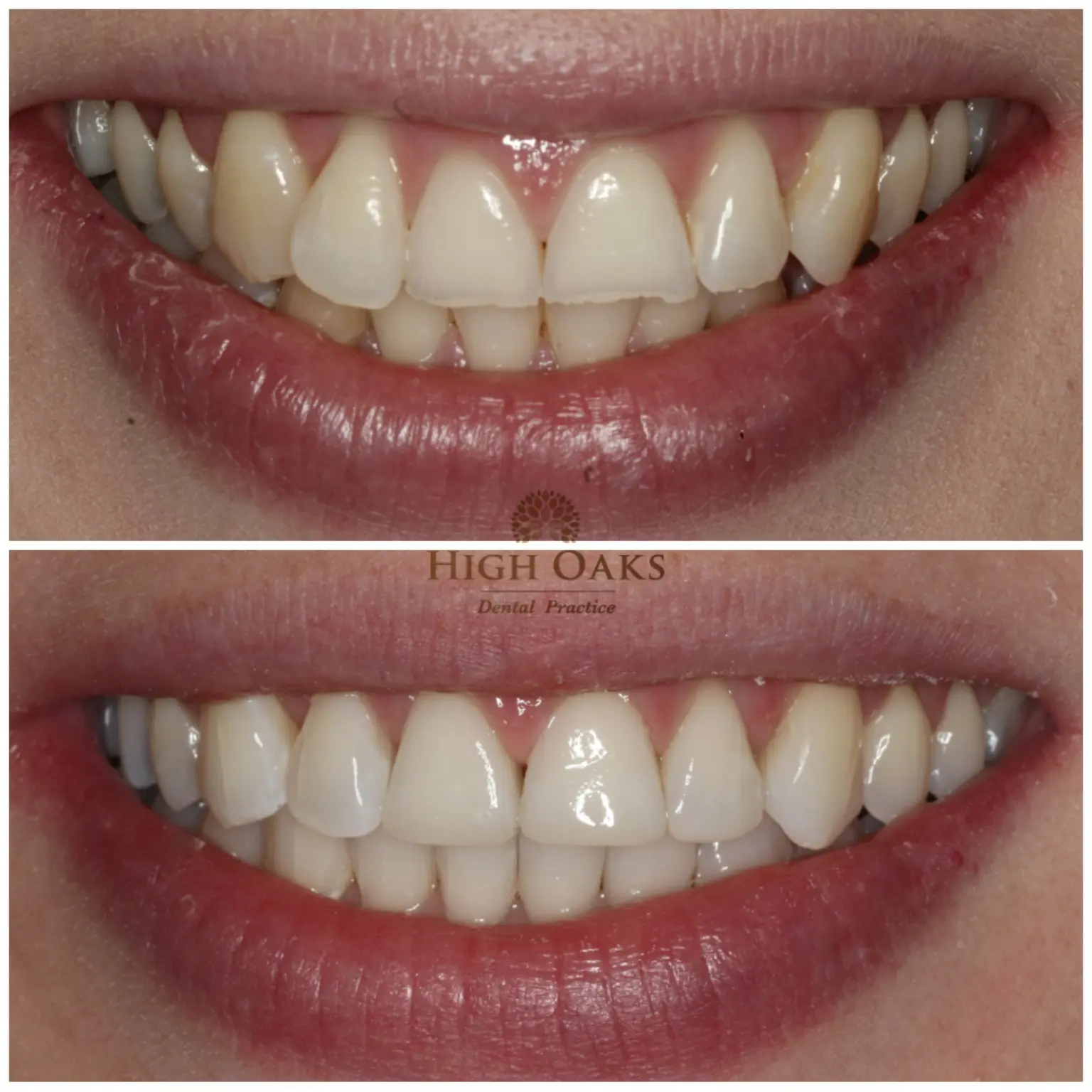 Genuine DNTL Group clear aligner case showing a smile before and after treatment